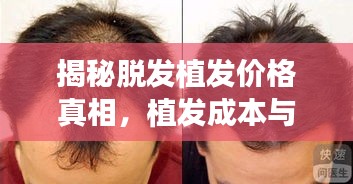揭秘脫發(fā)植發(fā)價(jià)格真相，植發(fā)成本與最佳方案選擇全解析